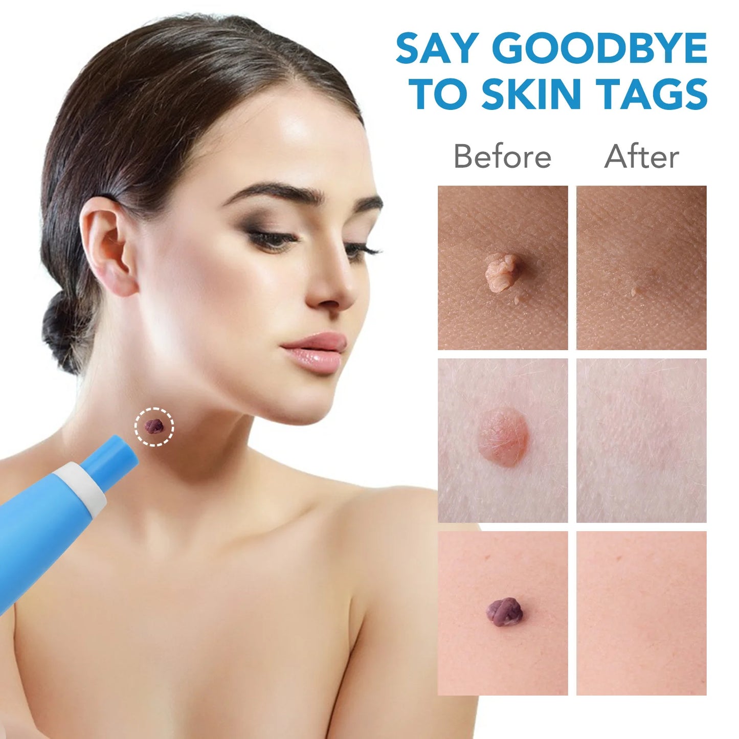Skin Tag Remover Kit