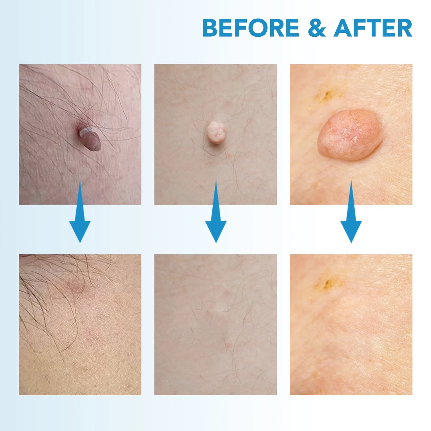 Skin Tag Remover Kit